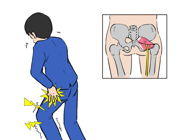【西葛西・篠崎】坐骨神経痛に整体で根本からアプローチできる整骨院