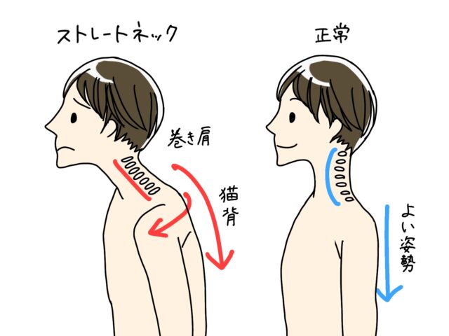 頭痛改善なら整骨院へ｜ストレートネックと姿勢を根本ケア