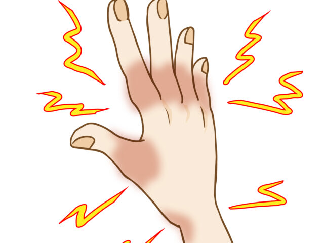 その「手首の痛み」放置していませんか？腱鞘炎・ばね指は早期施術で改善！