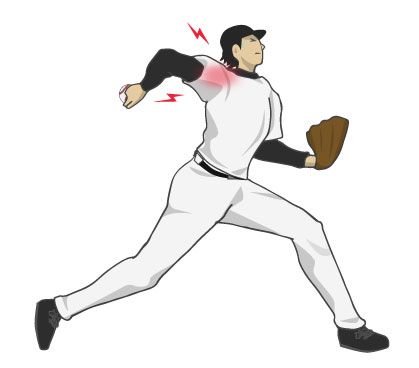 その野球肩、肩だけが原因じゃない｜学生・社会人対応の整骨院