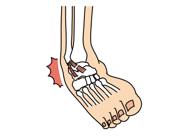 捻挫や肉離れは整骨院にお任せ｜改善から復帰までサポート